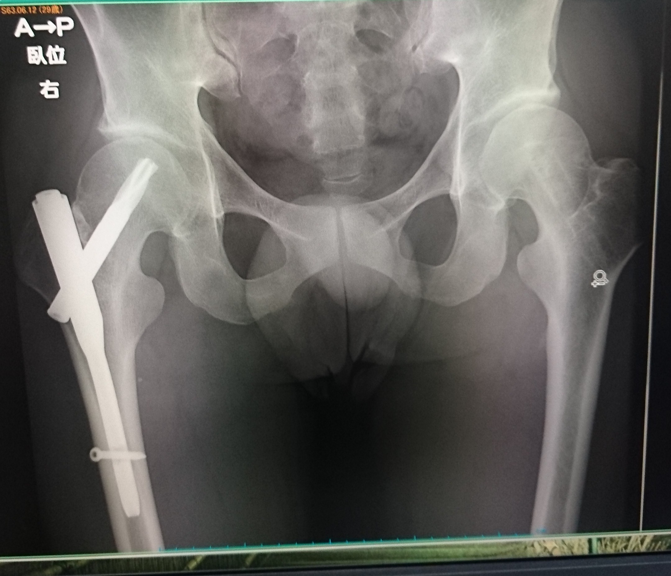 フルーム選手の現状を今ある情報で考えてみる プロサイクリスト 伊藤雅和